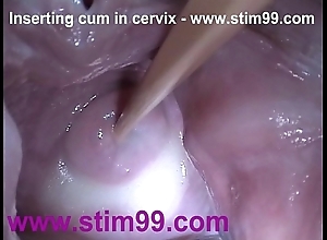 Intercalate semen cum in cervix involving dilation muff reflector